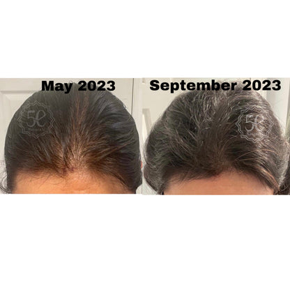 Best Onion and Rosemary Hair Oil for Growth